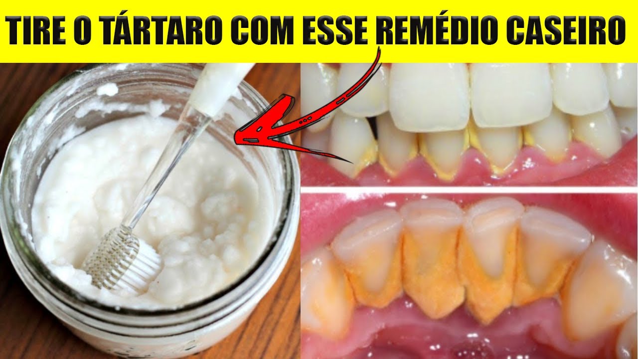 COMO TIRAR tártaro dos DENTES - COMO REMOVER tartaro dentes com tartaro ...