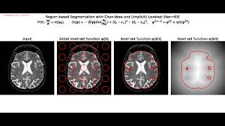 Region-based Segmentation | Chan-Vese | Snakes | Level Sets | Gradient Descent | python