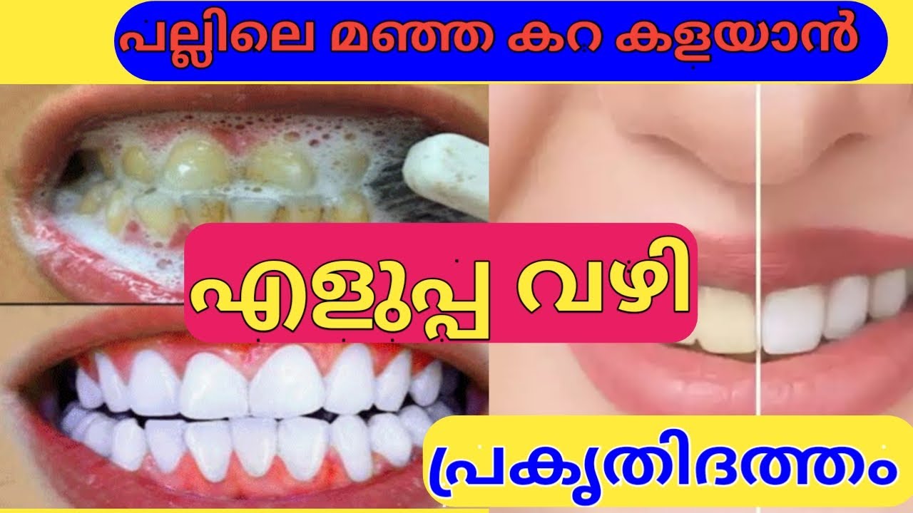 The easiest way to get rid of yellow stains on teeth | പല്ലിലെ മഞ്ഞ കറ കളയാന്‍ എളുപ്പ വഴി - YouTube