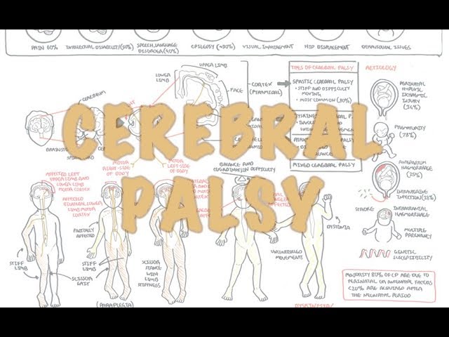 Cerebral Palsy - (DETAILED) Overview class=