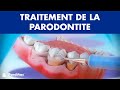 Curetage et détartrage - Traitement de la parodontite ©