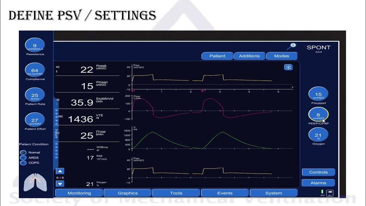 Modes of mechanical ventilation Pressure Support Ventilation (PSV