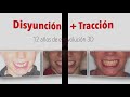 Tratamiento Disyunción Máscara Facial en Clase III Esquelética: 12 años de evolución.