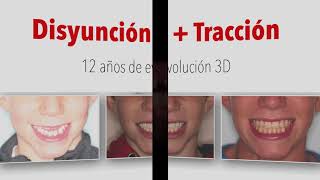 Tratamiento Disyunción Máscara Facial en Clase III Esquelética: 12 años de evolución.