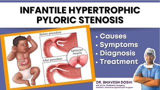 Infantile Hypertrophic Pyloric Stenosis - Causes, Symptoms, and Treatment | Dr. Bhavesh Doshi