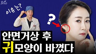 [SUB/성형지식] 뭐야 내 귓불 돌려줘요😥 절개리프팅(안면거상) 후 귀모양이 바꼈을 때 어떻게 해야할까?