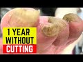 1 YEAR WITHOUT BEING CUT! 96-Year-Old Patient's Toenails
