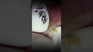 Relax Blackhead Removal 025  shorts   blackhead   acne  pimplesremoval  satisfying