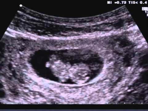 Test primo trimestre di gravidanza