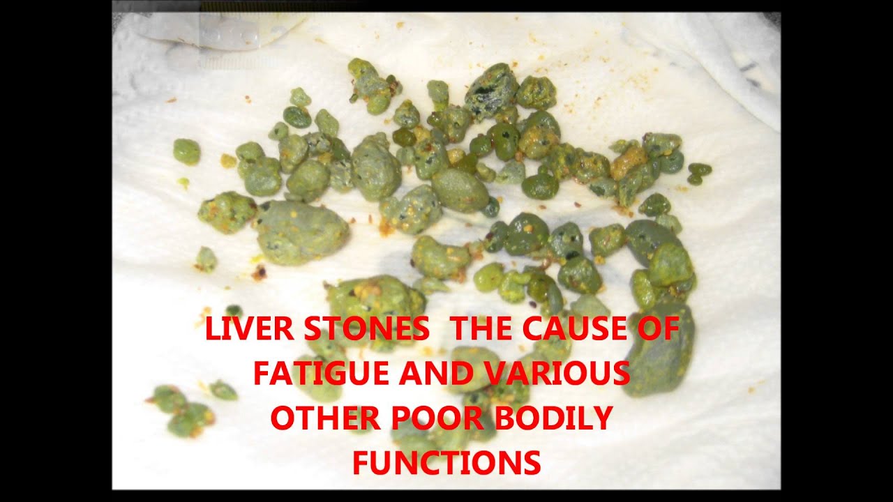 Results of Liver Flushing
