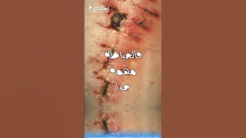 لو جرحك عميق هيعمل ندبة 