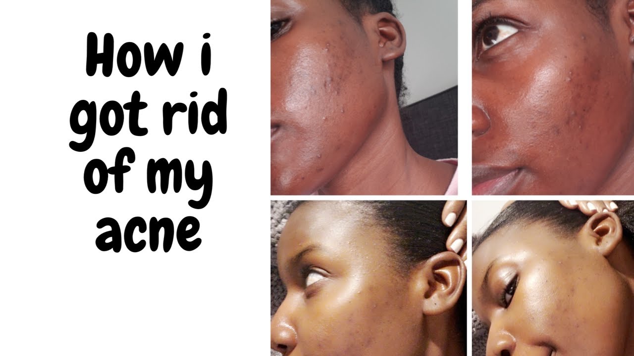 How i got rid of my Acne - Night time Skin Care Routine - YouTube