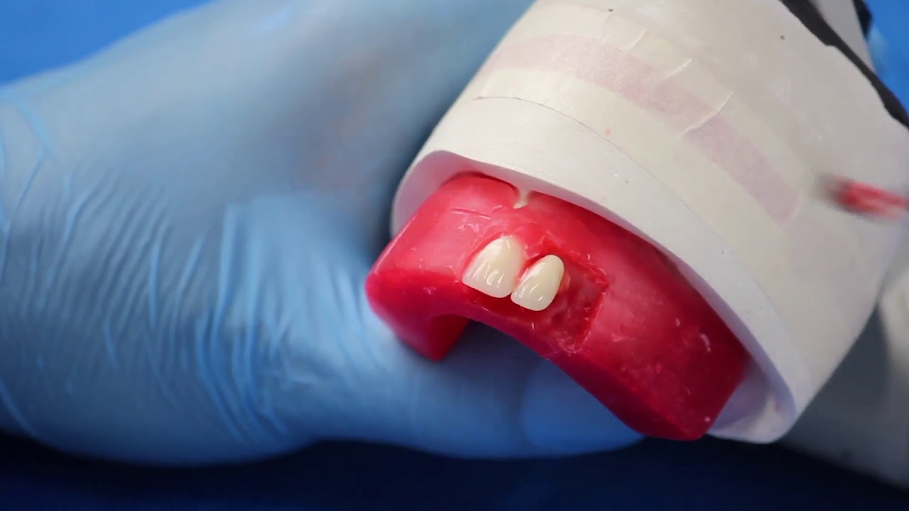 Montagem dos Dentes Artificiais Anteriores