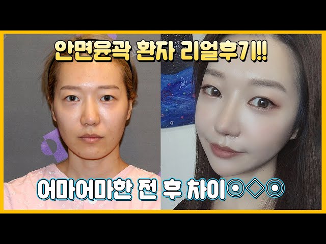 안면윤곽3종(+지방이식) 수술 후 U라인에서 V라인으로 돌아온 6달차 영상!