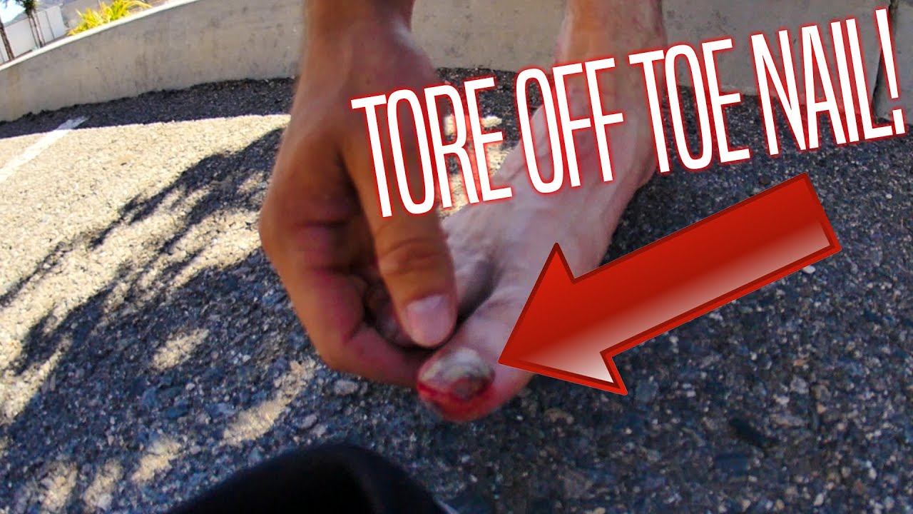 RIPPED OFF MY TOENAIL! YouTube