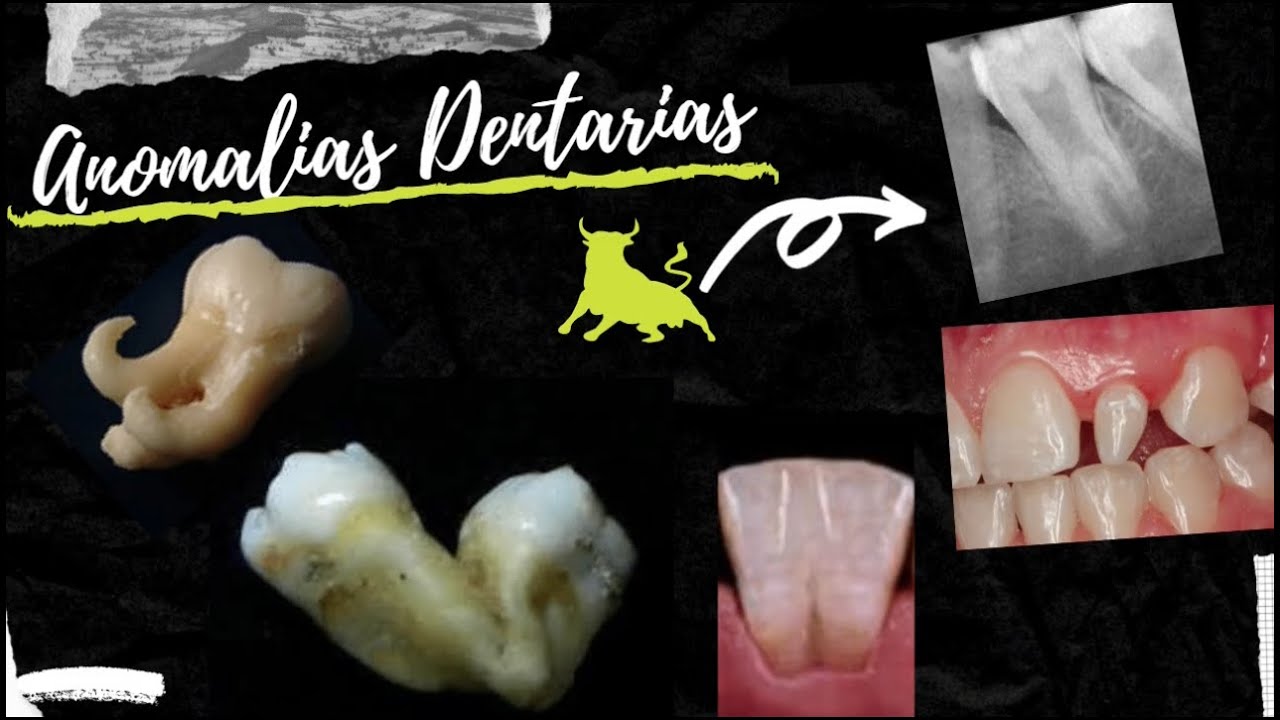 Anomalias Dentárias (Fusão,Geminação,Taurodontia etc...)