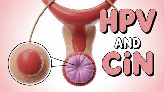 114. Cervical Intraepithelial Neoplasia (CIN) – Part 2 | USMLE Step 2 CK