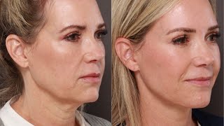 Will I Still Look Like Myself After A Facelift? Addressing Common Concerns with Facelift Surgery