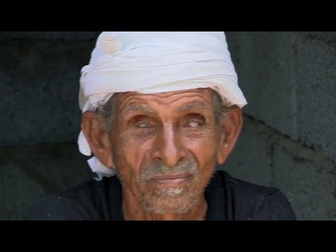 Genetik bozukluk Yemen'de bir köyü kör etti