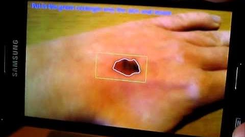 Skin Lesion Detection (2)