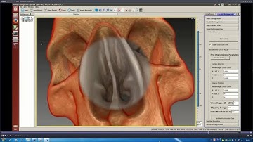 A Novel Augmented Reality Navigation System for Endoscopic Sinus and Skull Base Surgery