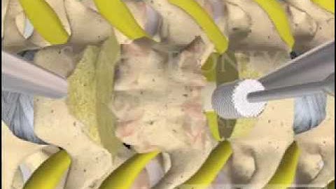 Cervical Spine Vertebrectomy Corpectomy with cage plate orthopeadic 3D animations