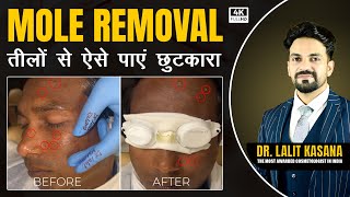 Mole Removal Treatment By Dr. Lalit Kasanas
