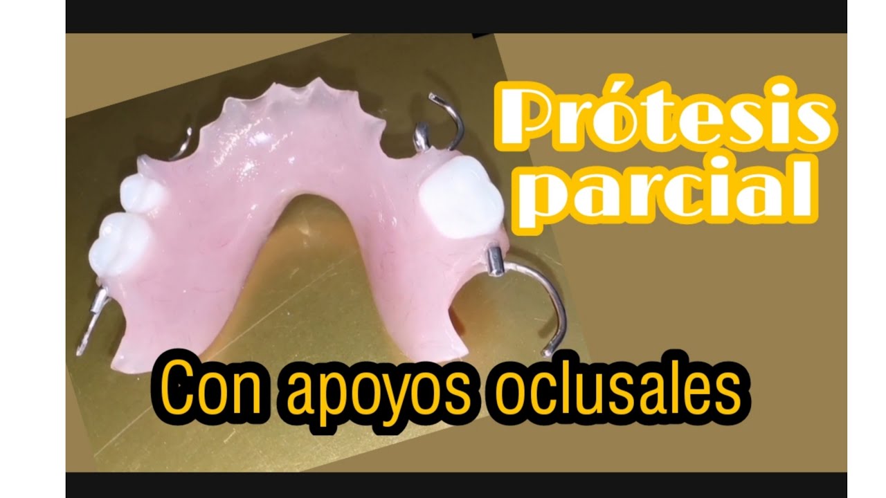 Prótesis parcial con ganchos forjados desde cero 🦷