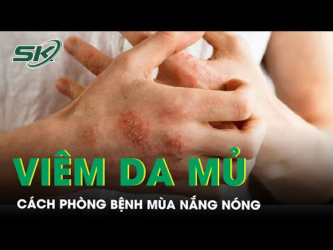 Cách Phòng Bệnh Viêm Da Mủ Khi Thời Tiết Nóng Nực 