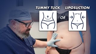 Tummy Tuck or Liposuction: What is the Best Procedure for Me?