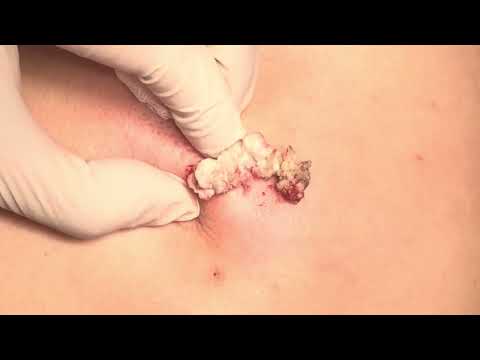 背部粉瘤切除 美麗新城診所莊禮謙醫師 Epidermal Cyst, Dr George