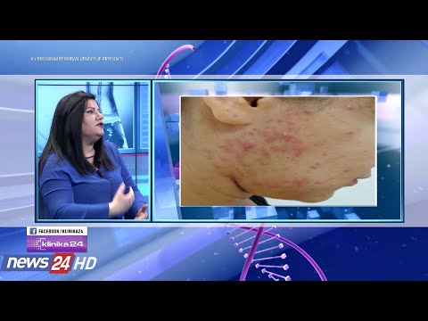 Video: Lëkura Gunga (dermatozat Papulonodulare) Macet