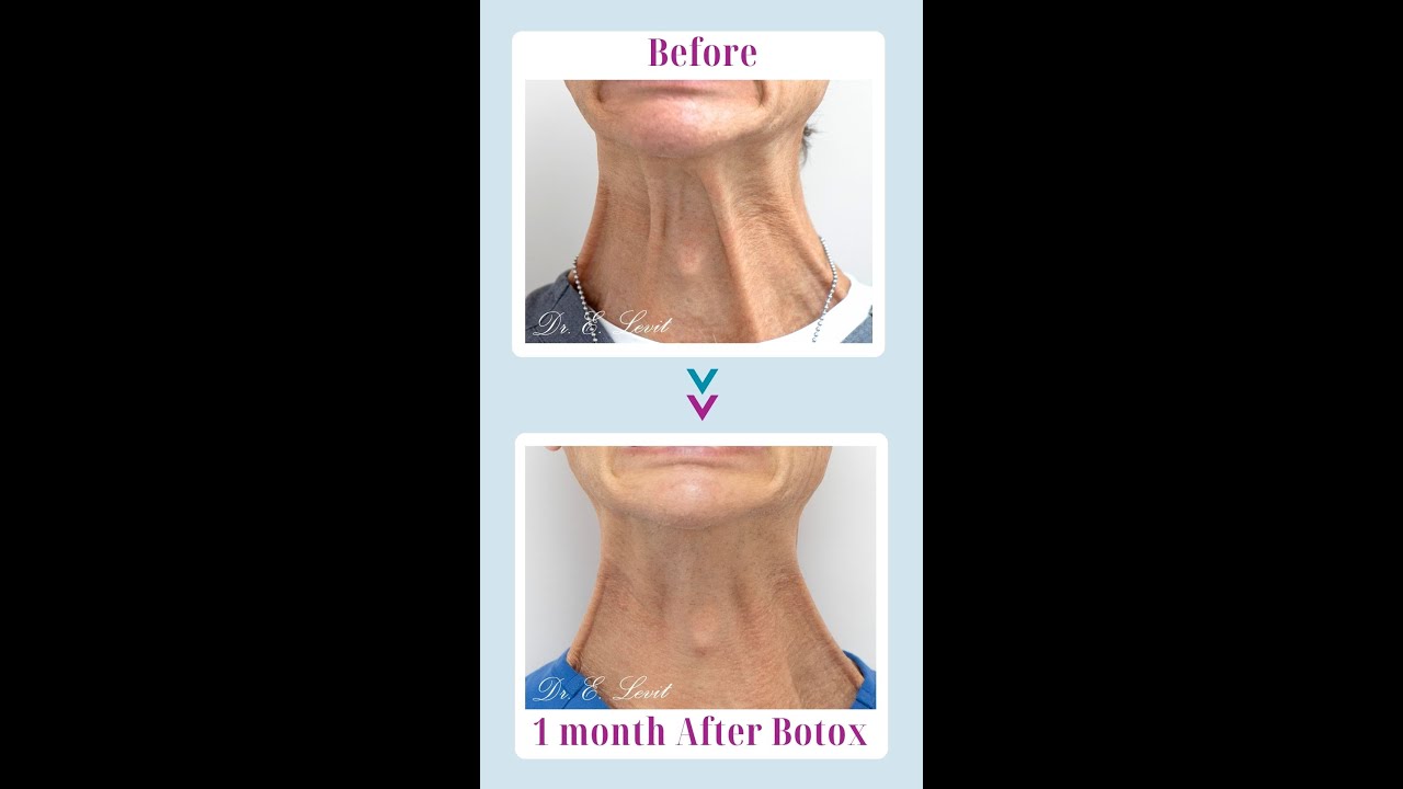 The Aging Neck: Tackling Wrinkles and Sagging Skin with Botox and Hollywood Laser ✨