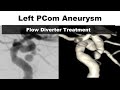PCom Aneurysm - Flow Diverter Treatment