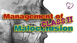 Management of Class II Malocclusion/Perawatan Maloklusi klas II
