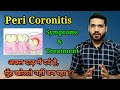 Peri coronitis , symptoms & treatment | अक्ल दाढ़ दर्द का एक कारण !