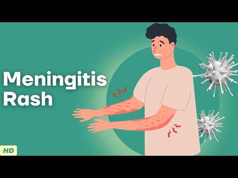 Video: Svrbia vyrážky pri meningitíde?