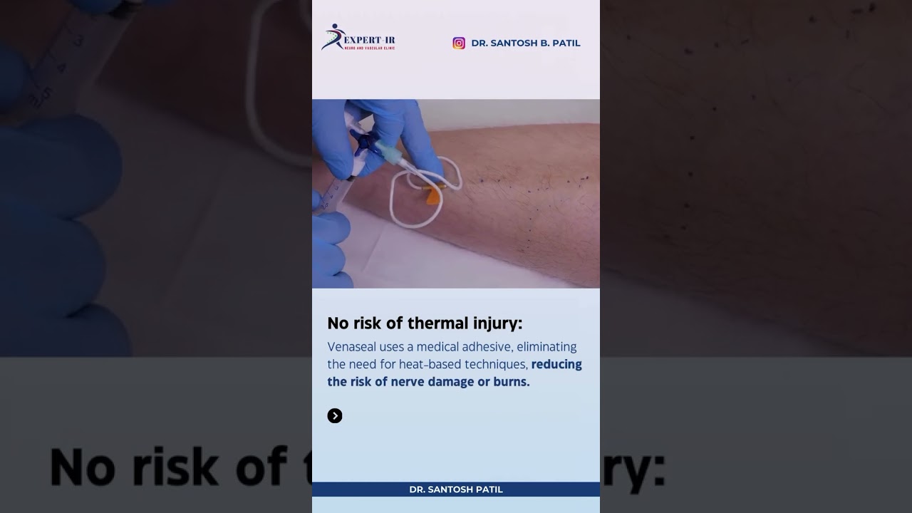 Venaseal Treatment for Varicose Veins | Venaseal Procedure | Benefits | Best Varicose Vein Treatment