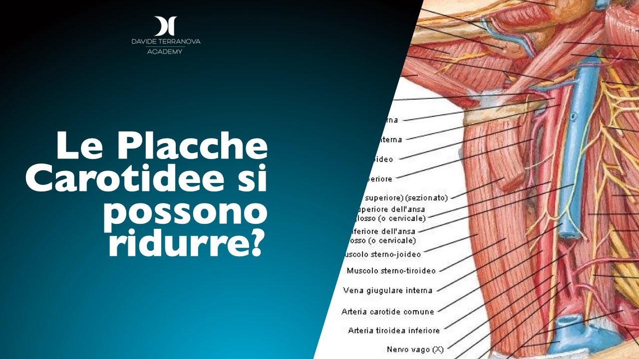 Le Placche Carotidee si possono ridurre?