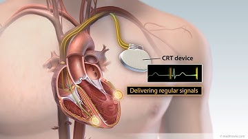 Cardiac Resynchronization Therapy
