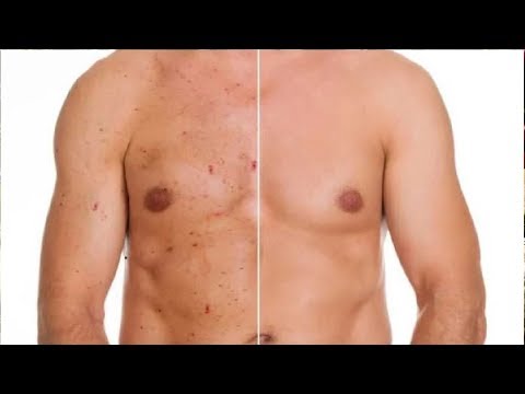 how to get rid of chest acne and back acne