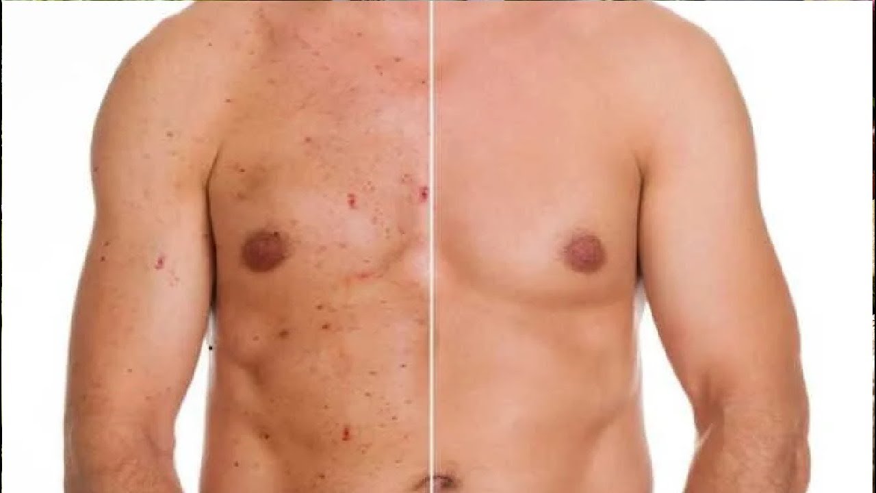 how to get rid of chest acne and back acne - YouTube