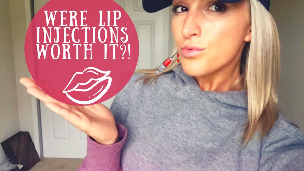 Was getting LIP INJECTIONS worth it? YouTube