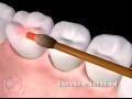 Denver CO Dentist Shares Video Animation of New Laser Periodontal Disease Treatment