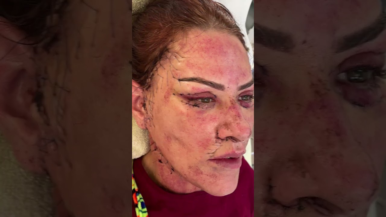 Hybrid Facelift Deep Plane Neck Lift by Dr Sozer #cosmeticsurgery