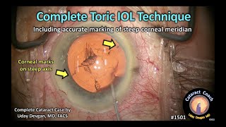 CataractCoach 1501: complete toric IOL technique - start to finish