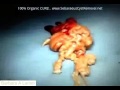 BIGGEST CYST SQUEEZE IN THE WORLD Operation Kill Birtha Barbara A Lamm BIGGEST CYST SQUEEZE IN THE WORLD Operation Kill Birtha Barbara A Lamm