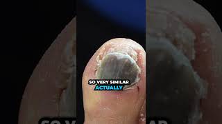 What is HIDING underneath this thick black toenail? 🦶