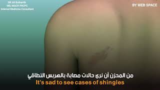 الحزام الناري - #الهربس_النطاقي - Herpes zoster - SHINGLES مع الدكتور علي بالحارث