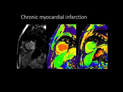 9. CMR Parametric Mapping Dr  Richa Kothari